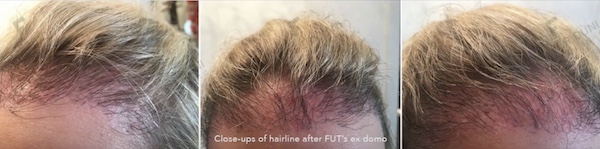 Risiken Haartransplantation - Beispiellfall Dr. Feriduni Frauen Repair - Reparatur, vor der Reparatur bei Dr. Feriduni