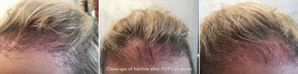 Risiken Haartransplantation - Beispiellfall Dr. Feriduni Frauen Repair - Reparatur, vor der Reparatur bei Dr. Feriduni Risiken Haartransplantation - Beispiellfall Dr. Feriduni Frauen Repair - Reparatur, vor der Reparatur bei Dr. Feriduni